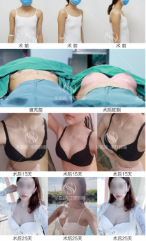 李朕体雕丰胸技术再升级,明显增加脂肪丰胸存活率!