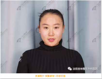 杏林双眼皮怎么样?改造内双+肿眼泡?术后完全大变样!